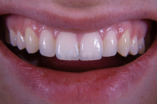Imagem de procedimento no dente
